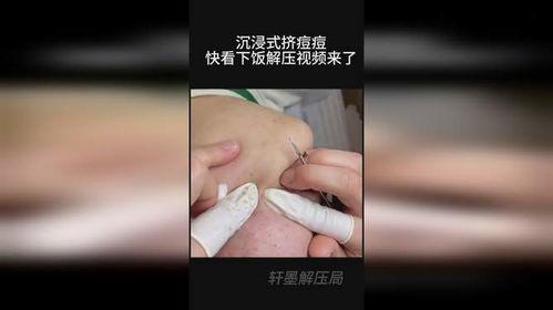 挤痘视频,专业技巧与注意事项