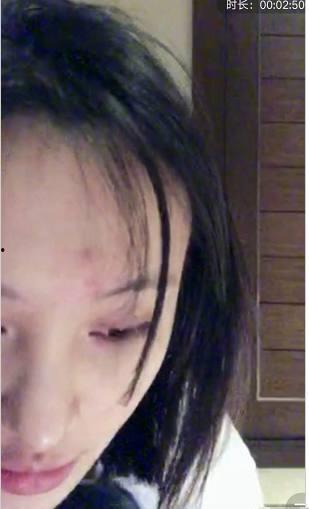 挤痘视频,专业技巧与注意事项