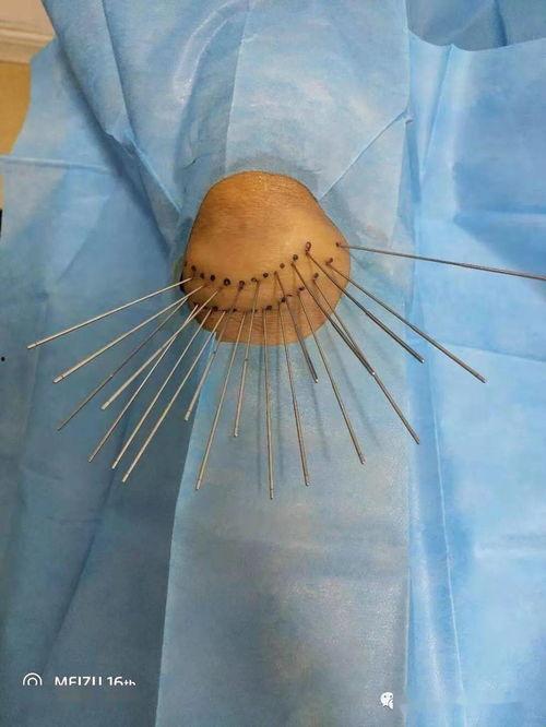 银质针视频,揭秘古老针法的现代应用与疗效