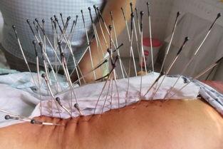 银质针视频,揭秘古老针法的现代应用与疗效