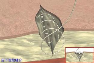 缝合视频教学,缝合技巧全解析